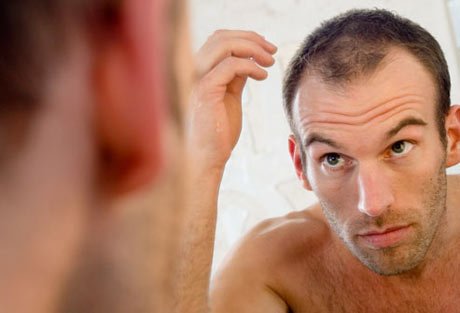 Hairstyles For Balding Men-1318